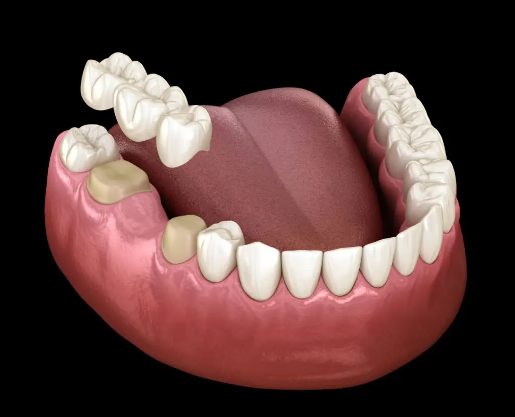 Dental Bridges in Wilmington: What Happens If You Do Not Replace a Missing Tooth?