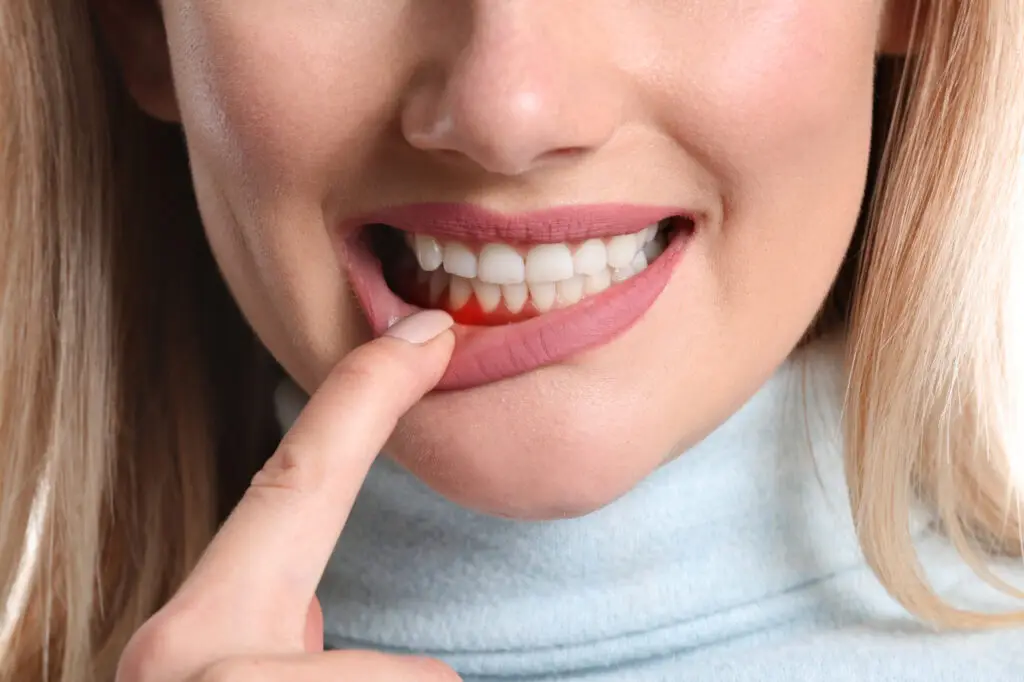 ICON Resin Infiltration in Wilmington: A Conservative Option for Certain White Spots on Teeth