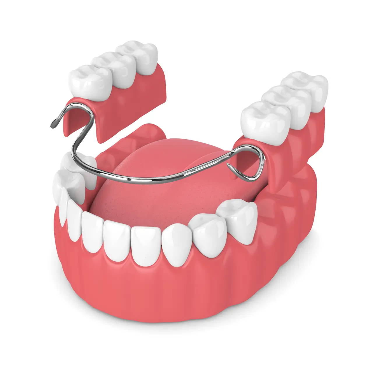 Snap-In Dentures vs. Traditional Dentures in Wilmington: Which Option May Be Right for You?
